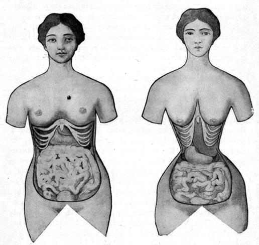 https://www.basementmedicine.org/wp-content/uploads/2015/05/corset-training-before-and-after.jpg